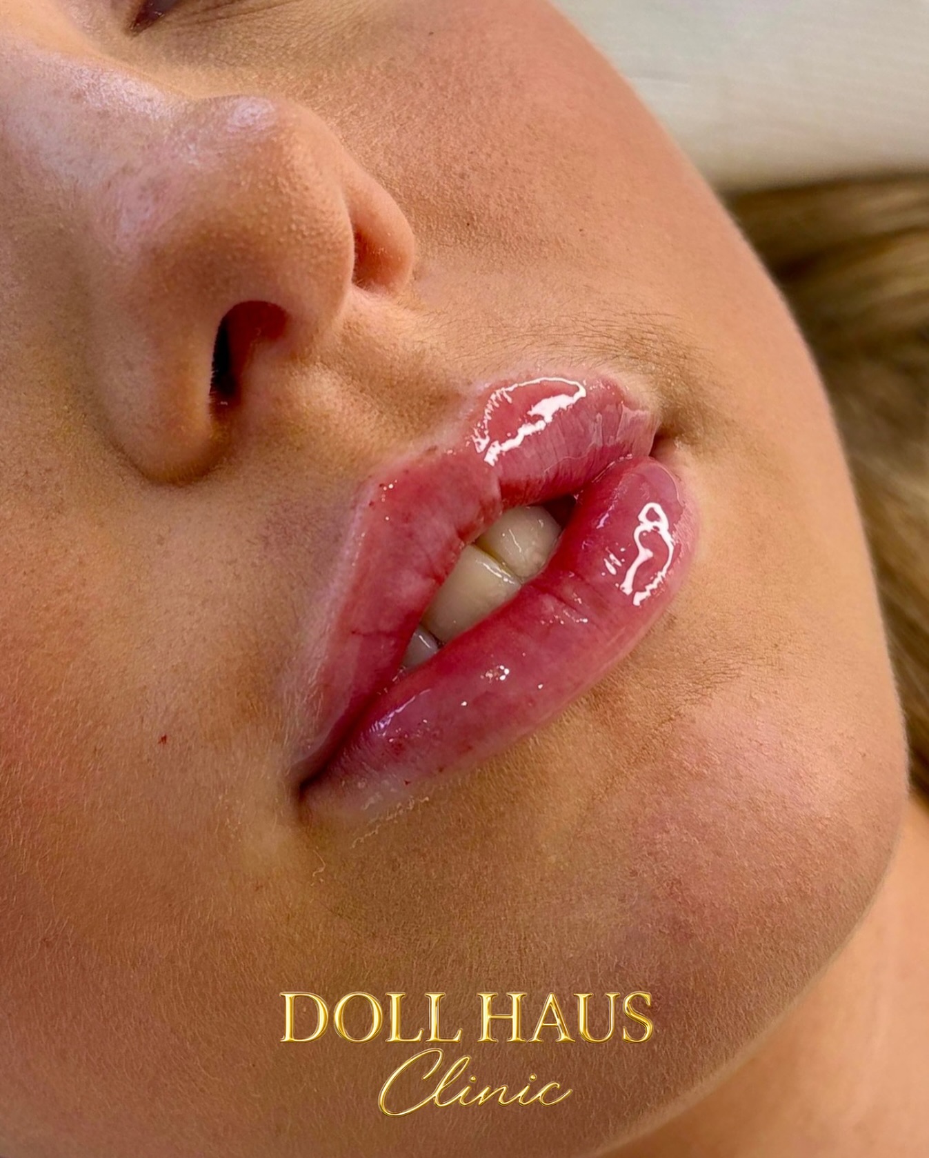 Natural, glossy lip enhancement result at Doll Haus Clinic